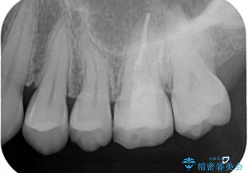 海外転勤前にセラミック治療の治療前