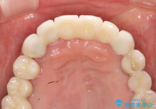 歯周病 全顎治療の治療後