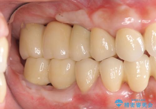 歯周病 全顎治療の治療後