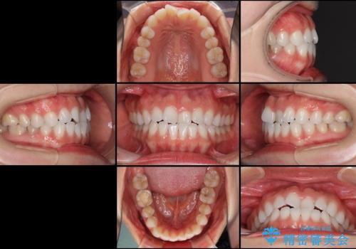 反対咬合を治したい インビザラインによる矯正治療の治療前
