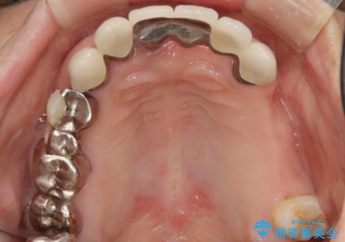 歯周病 全顎治療の治療前