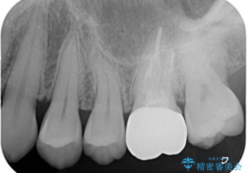 海外転勤前にセラミック治療の治療後