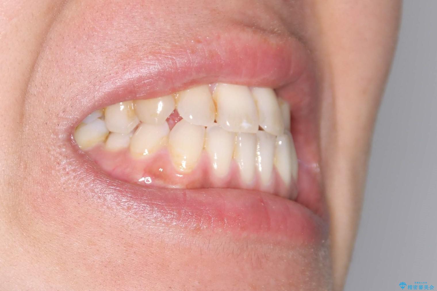 Invisalign インビザライン によるガタつき、受け口傾向の改善の治療前(顔貌)