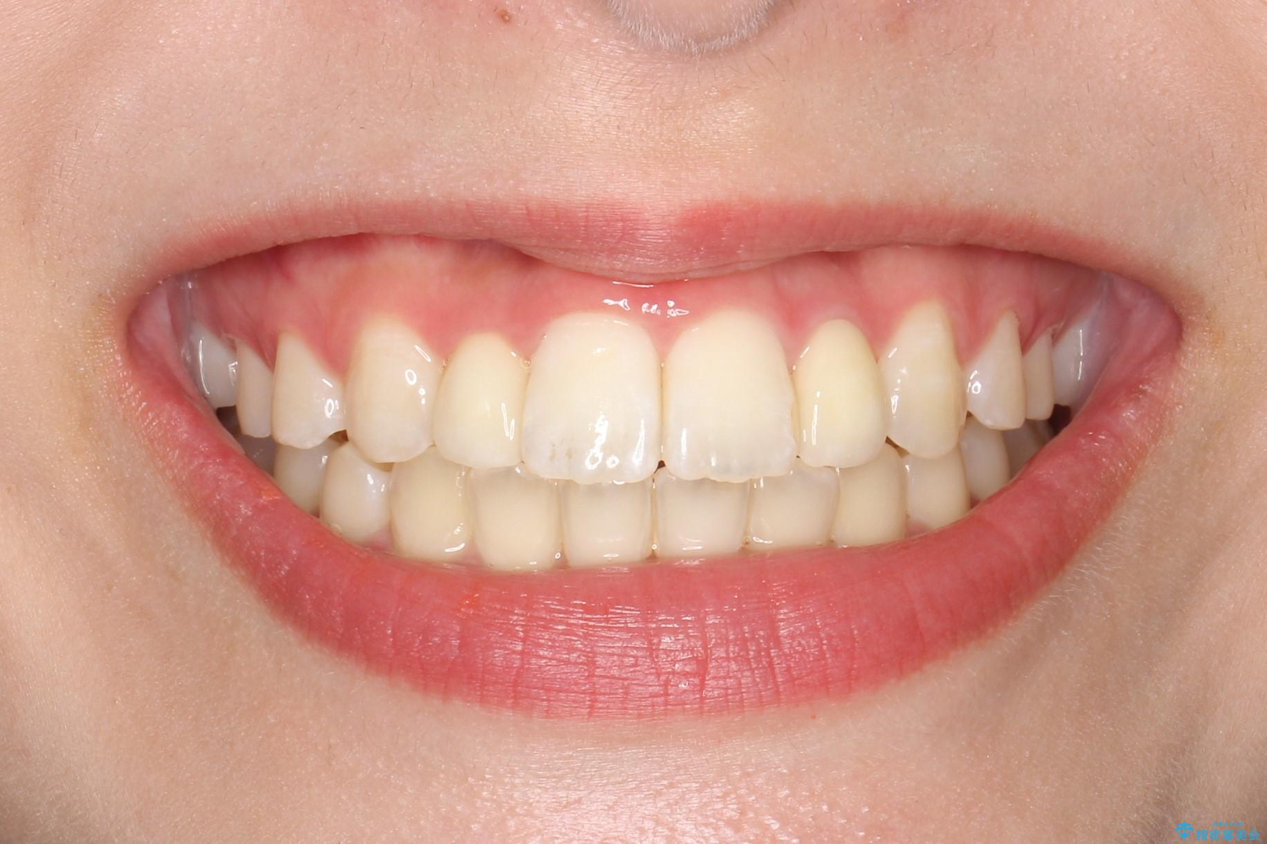 歯の形態修正も含めた矯正治療&セラミック治療の治療後(顔貌)