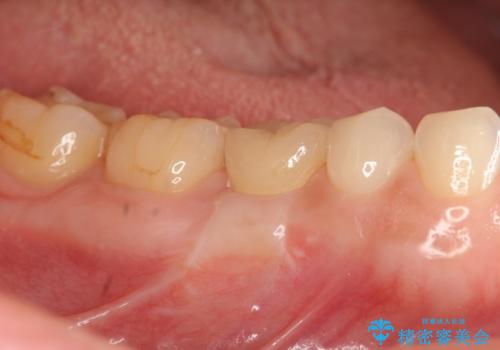 残せなくなってしまった乳歯 インプラントによる補綴の症例 治療後