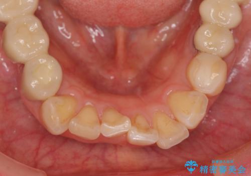 前歯の突き上げを改善する　インビザライン による小矯正の治療前