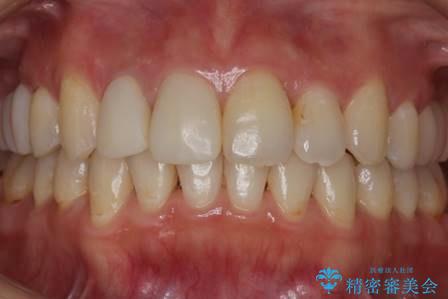 歯を透明感のある白さに。の症例 治療前