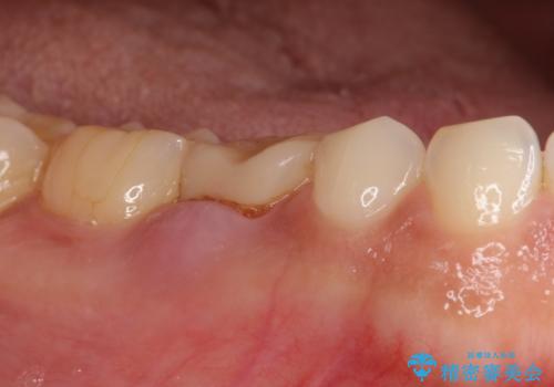 残せなくなってしまった乳歯 インプラントによる補綴の症例 治療前