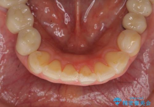 前歯の突き上げを改善する　インビザライン による小矯正の治療後