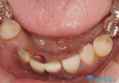 歯周病 全顎治療の治療前