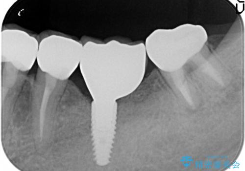 骨が薄い部位への骨造成をともなうインプラントの治療後