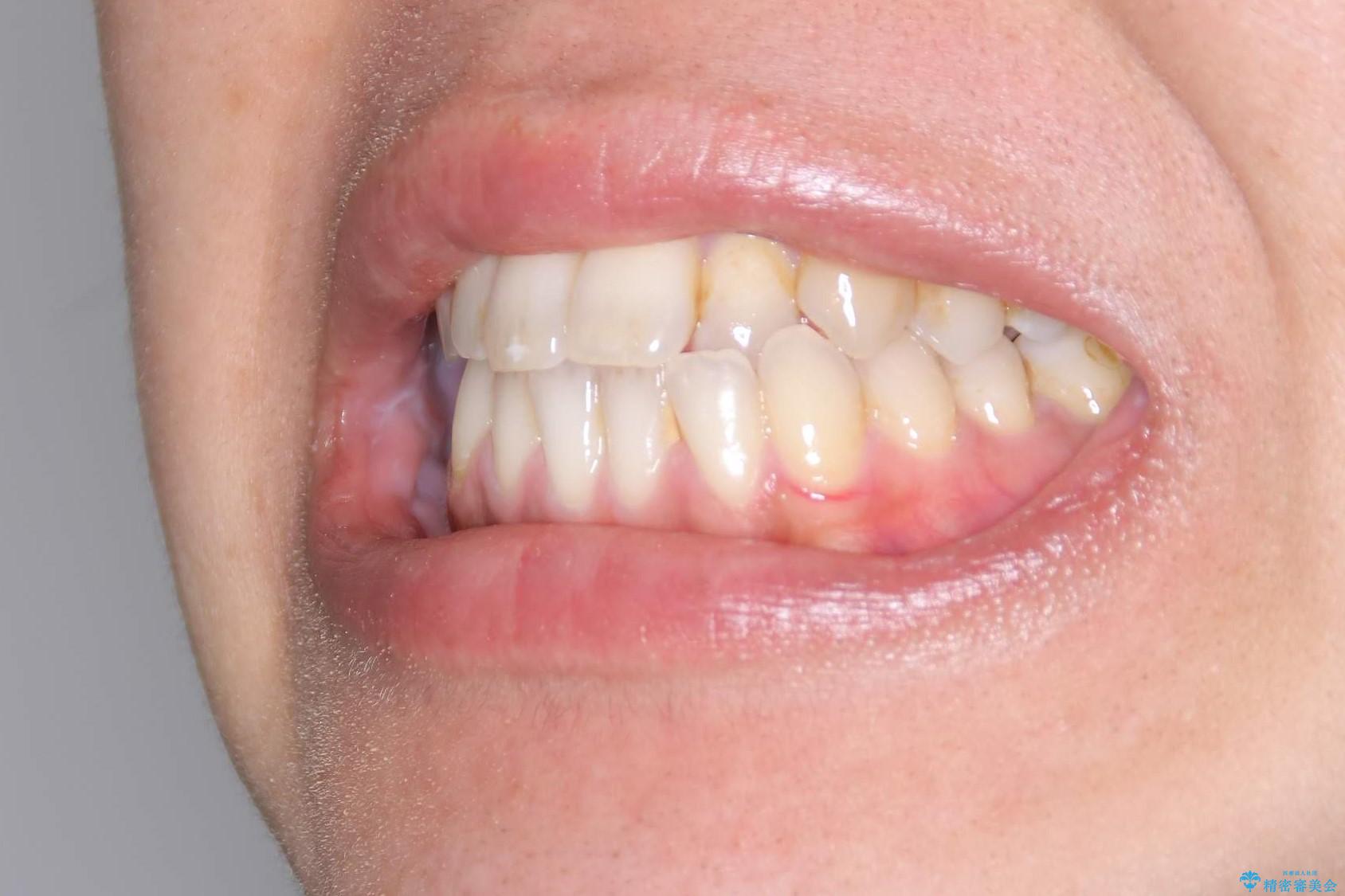 Invisalign インビザライン によるガタつき、受け口傾向の改善の治療前(顔貌)