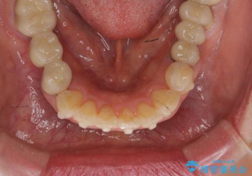 前歯の突き上げを改善する インビザライン による小矯正の治療中