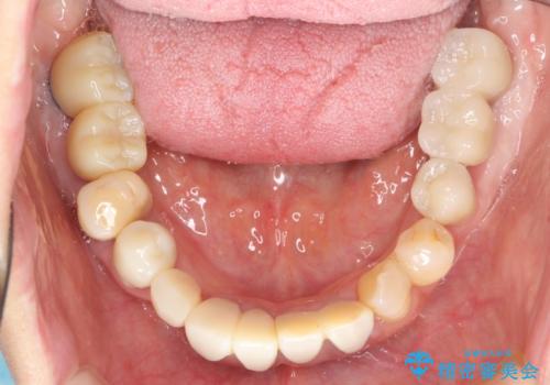 歯周病 全顎治療の治療中