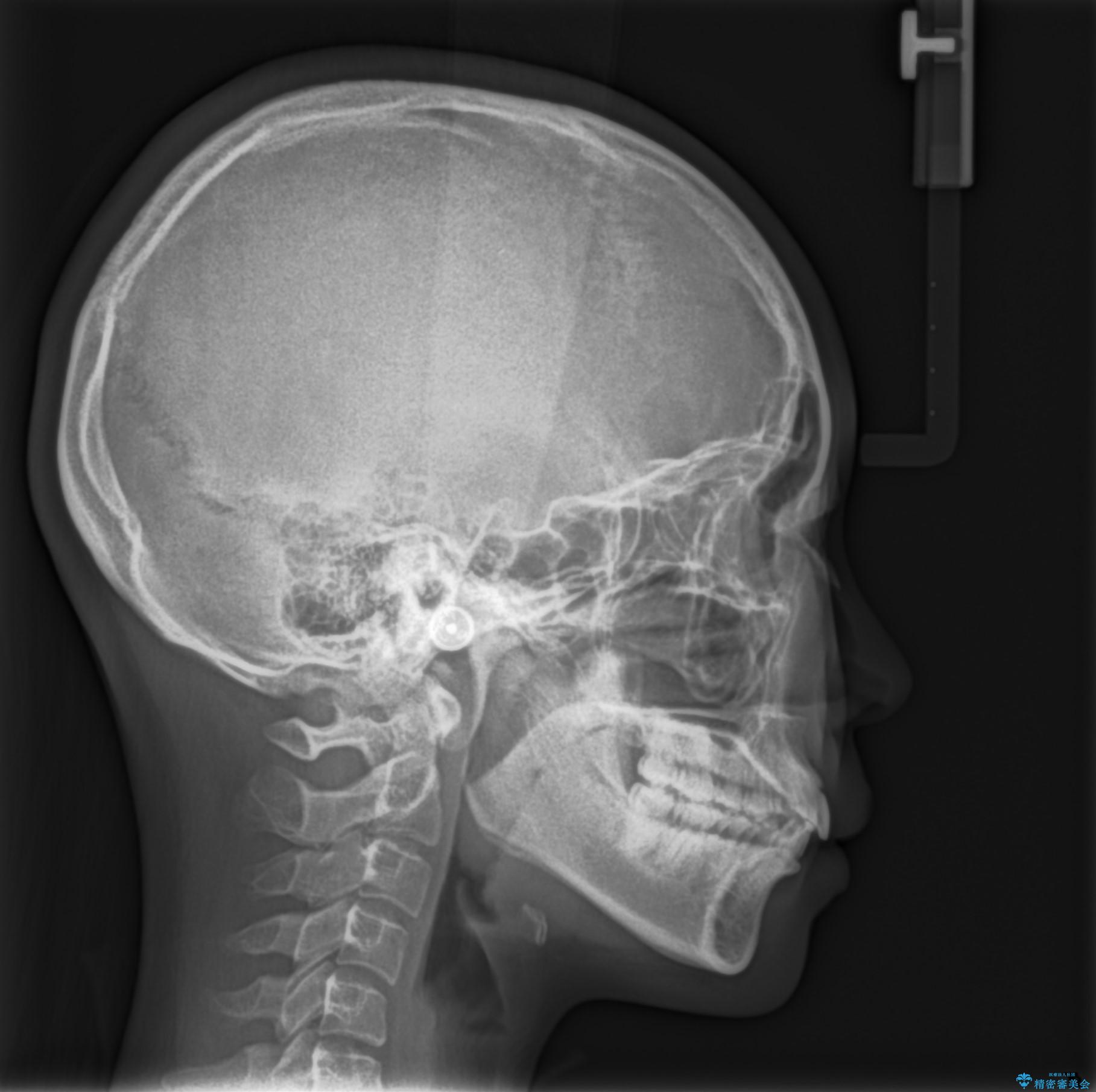 前歯の隙間を閉じたい。インビザラインによる治療の治療前(顔貌)