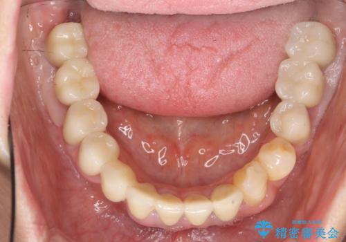 歯周病 全顎治療の治療後