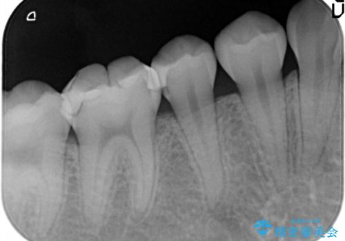 自然な見た目のセラミックインレーの治療前