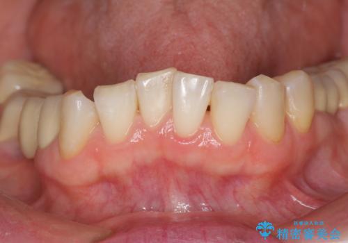 前歯の突き上げを改善する　インビザライン による小矯正の治療前