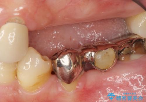 歯周病 全顎治療の治療前