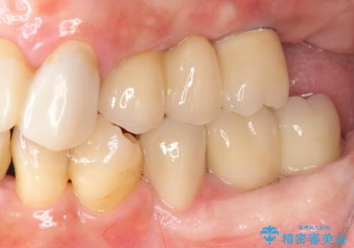 歯周病 全顎治療の治療中