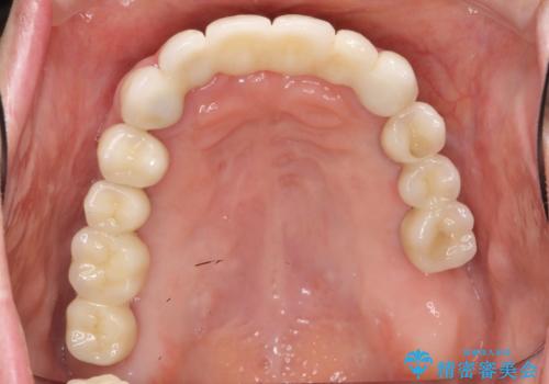 歯周病 全顎治療の治療後
