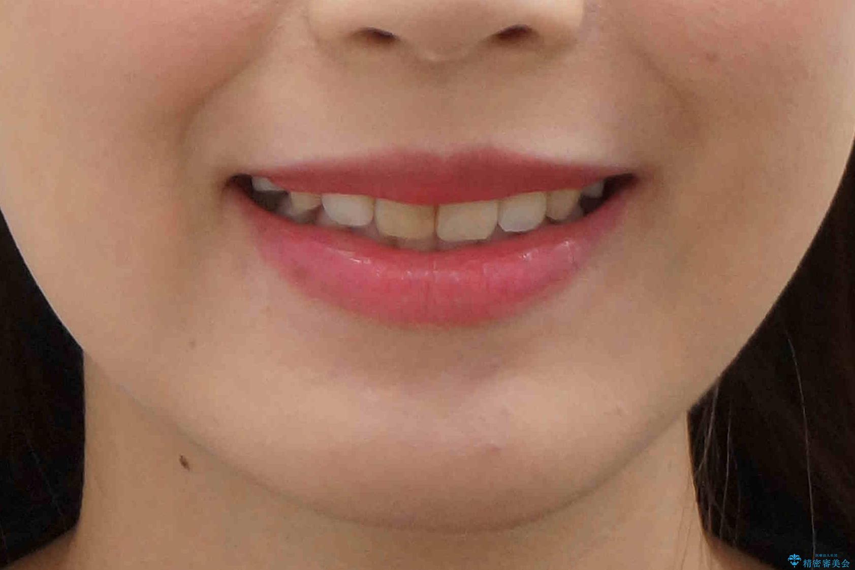 八重歯 前歯のがたがた 抜歯してワイヤー矯正の治療後(顔貌)