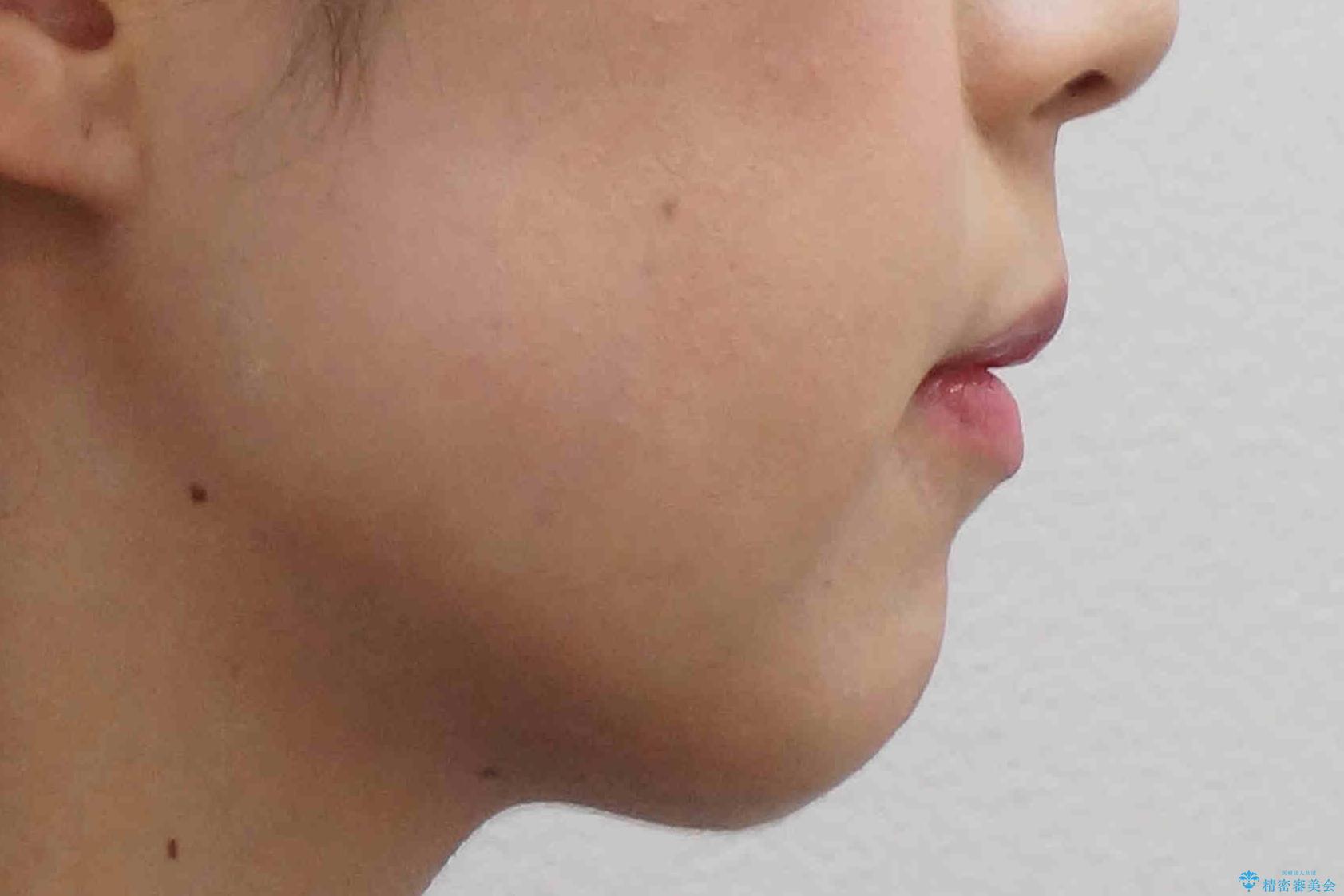 八重歯 前歯のがたがた 抜歯してワイヤー矯正の治療後(顔貌)