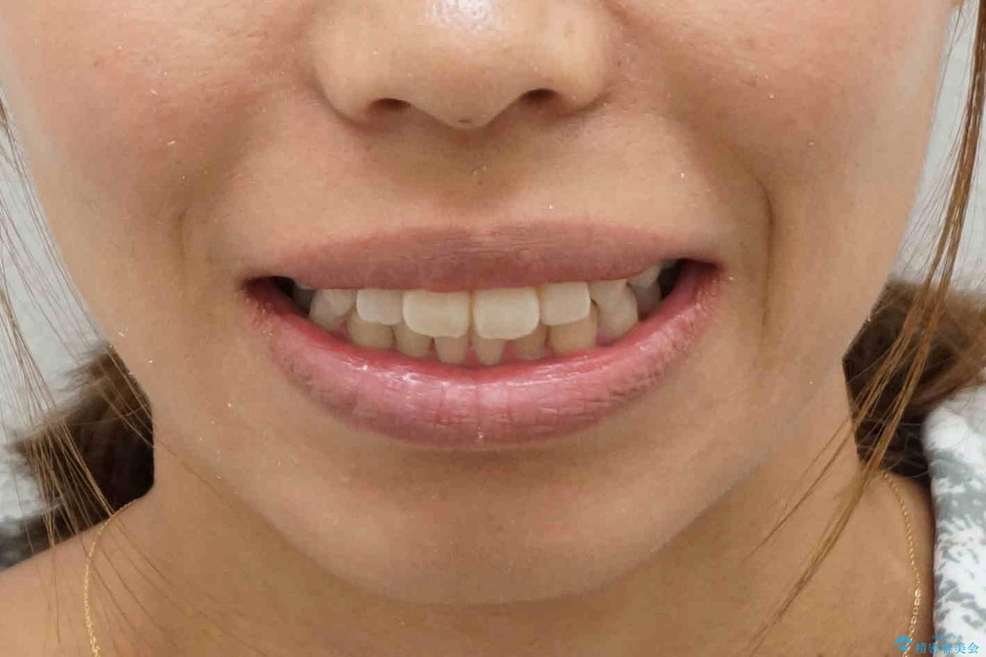 八重歯 抜かずにマウスピース矯正治療の治療後(顔貌)