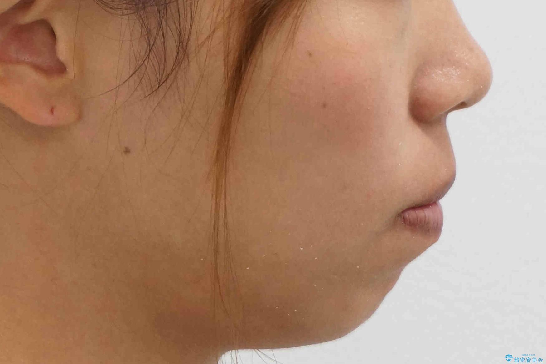 八重歯 抜かずにマウスピース矯正治療の治療後(顔貌)