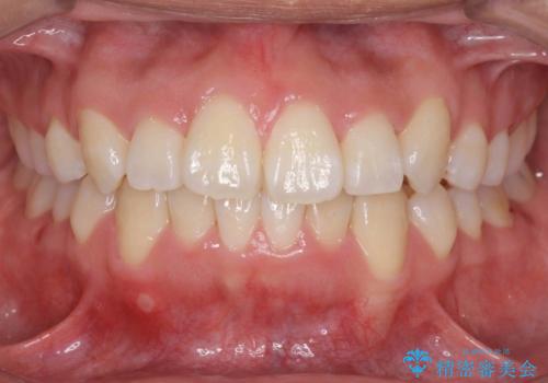 八重歯　抜かずにマウスピース矯正治療の症例 治療後