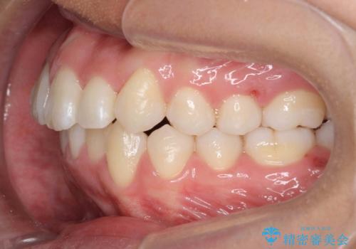 八重歯 抜かずにマウスピース矯正治療の治療後