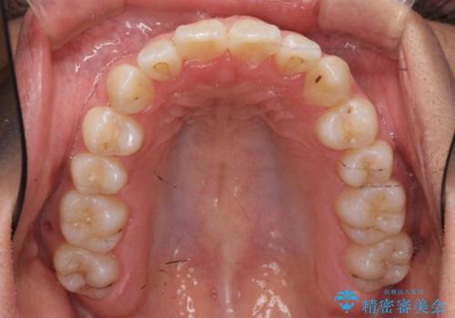 八重歯 抜かずにマウスピース矯正治療の治療後