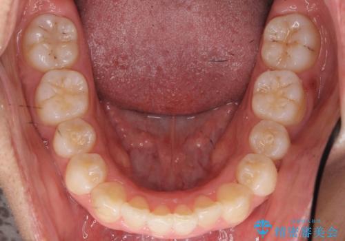 八重歯 抜かずにマウスピース矯正治療の治療後