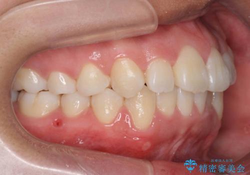 八重歯 抜かずにマウスピース矯正治療の治療後