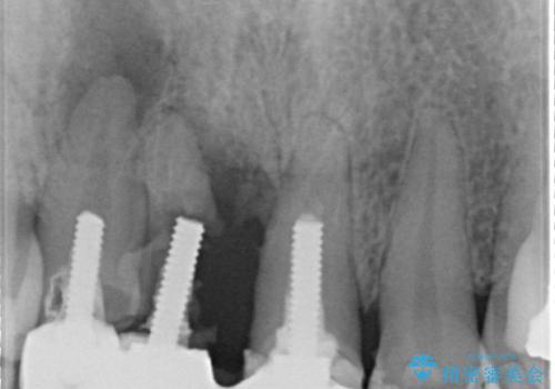 矯正を併用した前歯のセラミックブリッジ治療の治療前