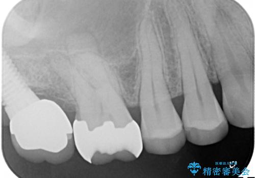感染した奥歯　痛くて咬めない　根管治療→かぶせ物で痛みを取り除き、かみ合わせを回復するの治療前