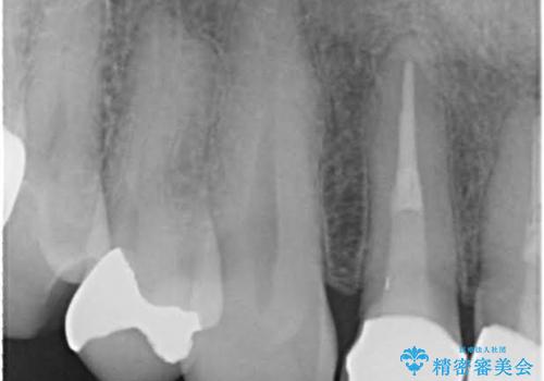金属だらけの奥歯　根管治療のやり直しとセラミック化の治療前