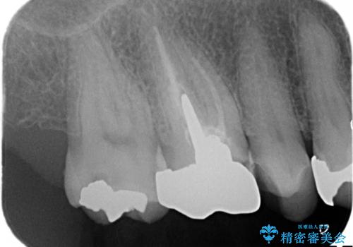 金属だらけの奥歯 根管治療のやり直しとセラミック化の治療前