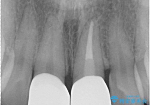 前歯の長さを揃える　歯周外科とセラミックの治療後