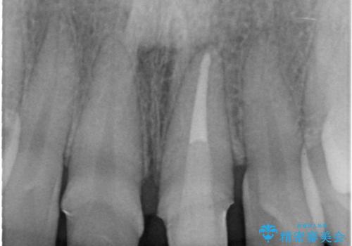前歯の長さを揃える　歯周外科とセラミックの治療中