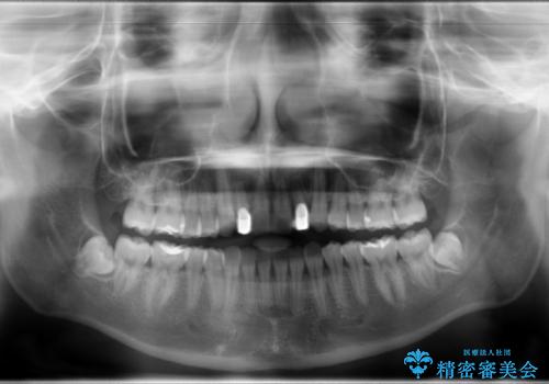 歯の形態修正も含めた矯正治療&セラミック治療の治療後