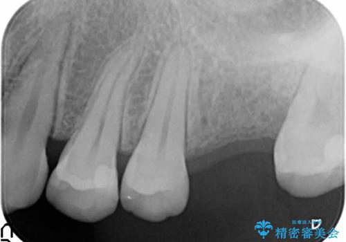 奥歯が割れてしまった!　→　インプラントによるかみ合わせの回復の治療前