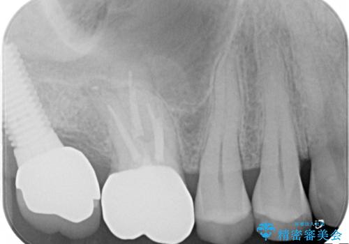 感染した奥歯　痛くて咬めない　根管治療→かぶせ物で痛みを取り除き、かみ合わせを回復するの治療中