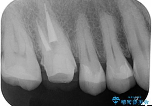 金属だらけの奥歯　根管治療のやり直しとセラミック化の治療中