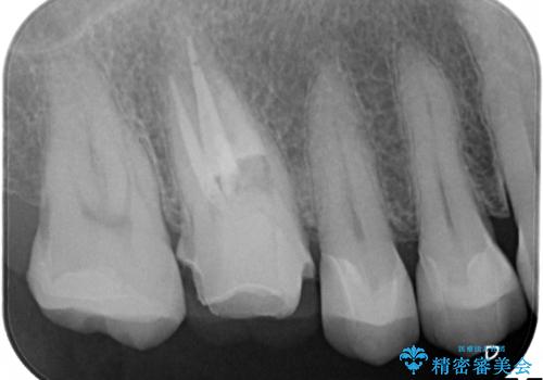 金属だらけの奥歯 根管治療のやり直しとセラミック化の治療中