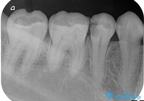 虫歯の治療 セラミックの詰め物で綺麗にの治療前