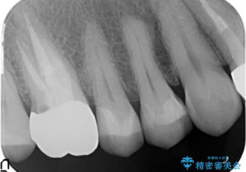金属だらけの奥歯　根管治療のやり直しとセラミック化の治療後