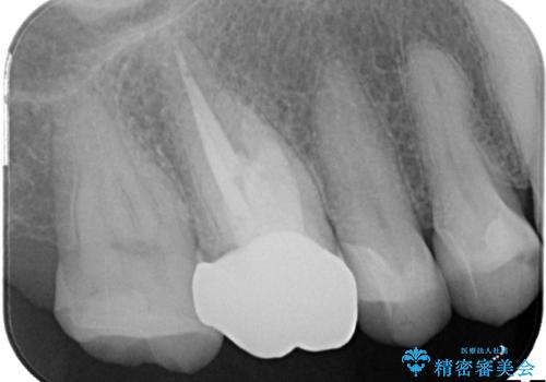 金属だらけの奥歯 根管治療のやり直しとセラミック化の治療後
