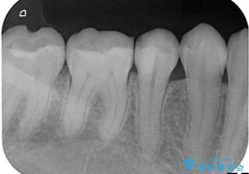 虫歯の治療 セラミックの詰め物で綺麗にの治療後