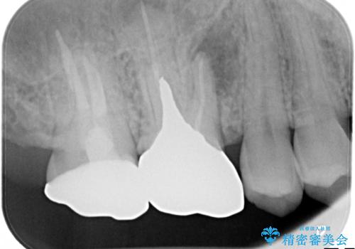 根っこの感染 再治療をしてかぶせ物を製作するの治療前